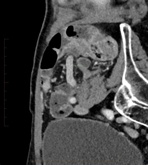 Acute Appendicitis On Ct Scan