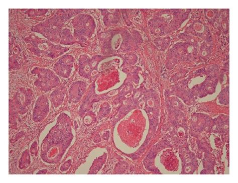 Gross Appearance Of The Resected Tumor Gross Examination Shows