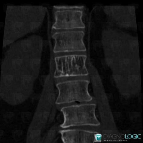 Radiology case : Hemangioma (CT ,MRI) - Diagnologic