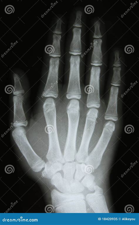 X-ray Image Of The Bones Of Arm Stock Image - Image: 18420935