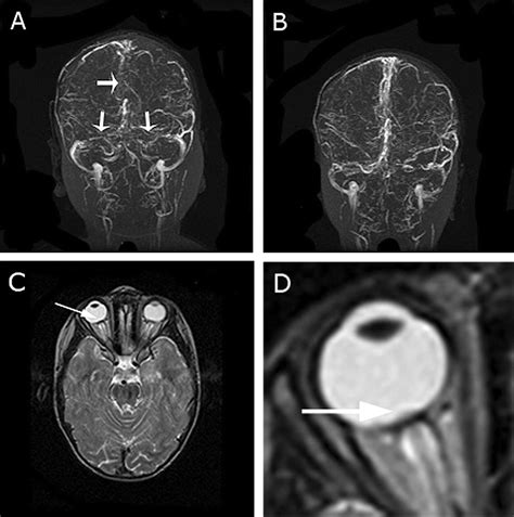 Teaching Neuroimage Mri Visualization Of Papilledema Associated With