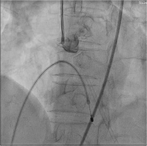 Tctap C 109 Managing Almost Every Procedural Complication Imaginable