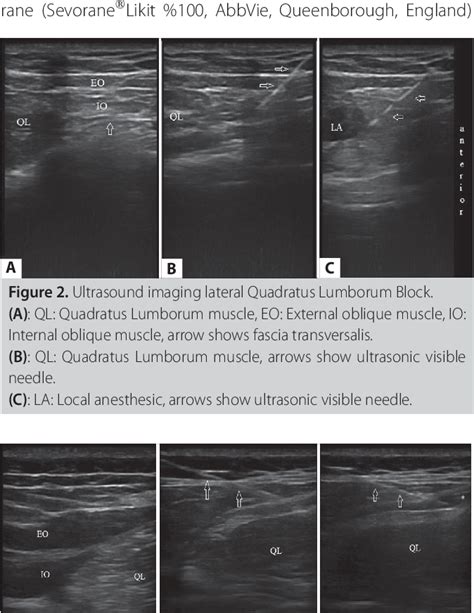 Figure From Ultrasound Guided Lateral Versus Posterior Quadratus