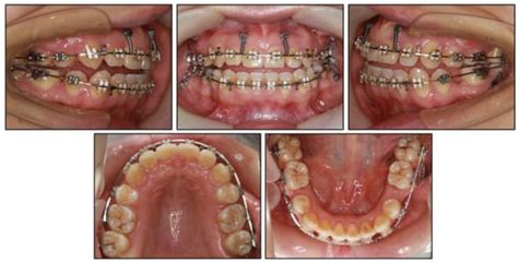 Medicina Free Full Text Vertical Control Of A Severe Hyperdivergent Skeletal Class Ii