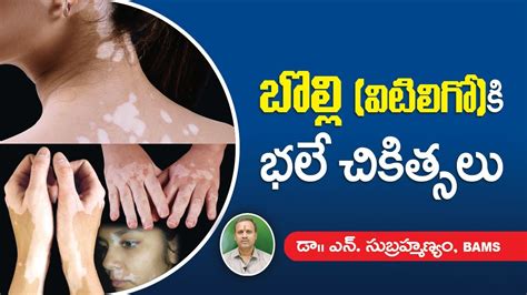 Leucoderma Causes And Treatment Vitiligo బొల్లి వ్యాధిని ప్రారంభంలోనే పోగొట్టుకోండి Youtube