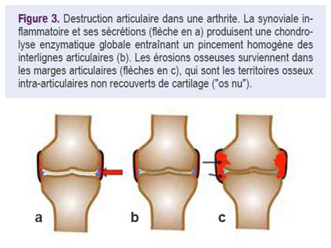 Arthropathies Interphalangiennes Distales Analyse L Mentaire Le