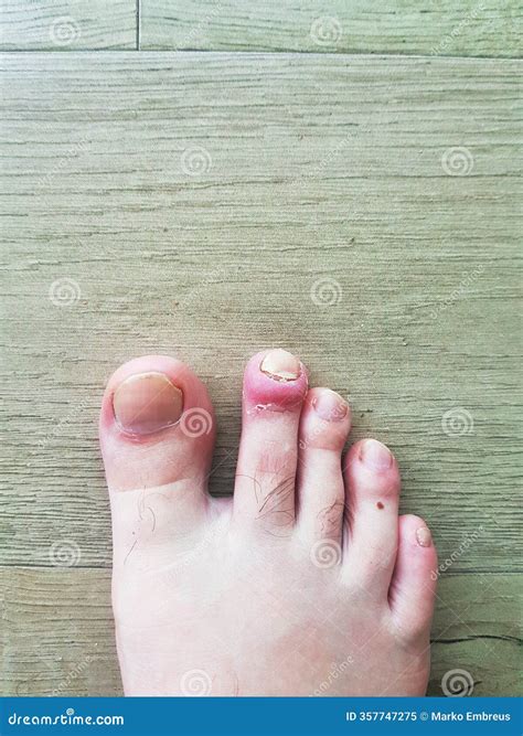 Toenails Damaged By Hematoma. Detachment Of The Nail, Blow To The Nail