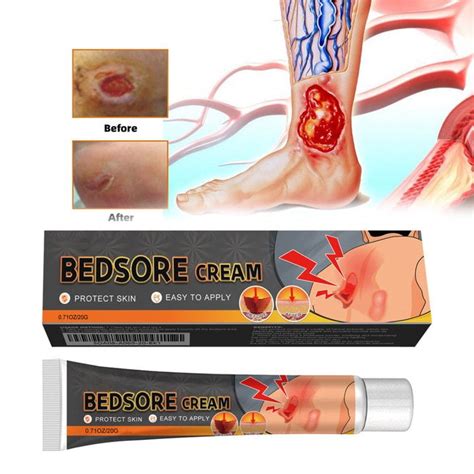 Bed Sore Cream,Bedsore Ointment,Ulcer Cream,Fast acting,Wound Healing ...