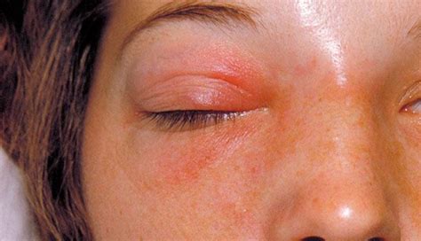 Periorbital Cellulitis Adult