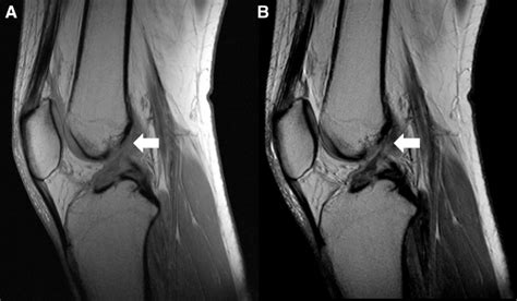 Two Sagittal Magnetic Resonance Images T1 A And T2 B Of Right