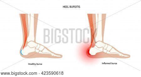 Heel Bursitis Vector & Photo (Free Trial) | Bigstock