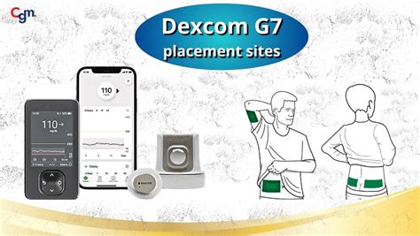 dexcom  placement sites thigh arm  abdomen
