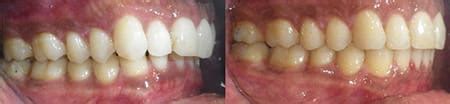 SureSmile Before and After Pictures in Atlanta, GA