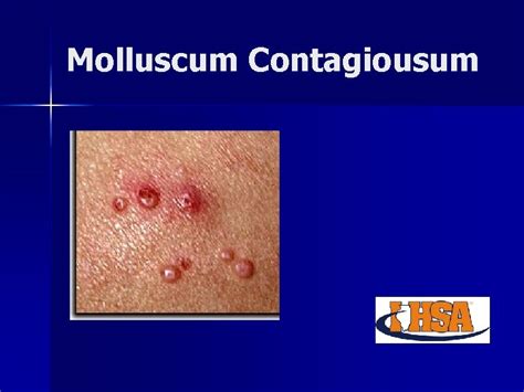 Common skin conditions in wrestling Ringworm Impetigo Mulluscum