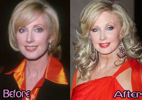 Chatter Busy Morgan Fairchild Plastic Surgery