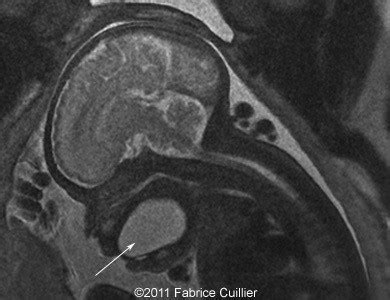 📃 Ranula, Benign mucous cyst