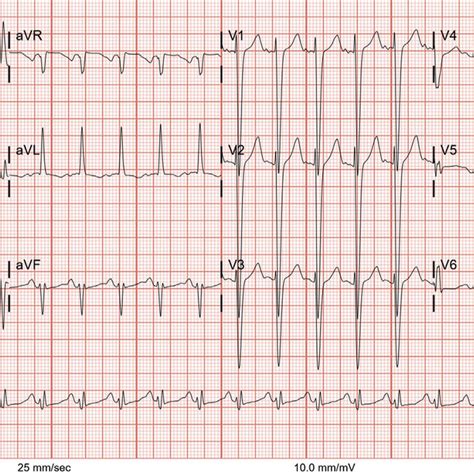 Initial Electrocardiogram On Presentation Showed Normal Sinus Rhythm