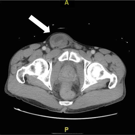 Ncp Incarcerated Inguinal Hernia | Images and Photos finder