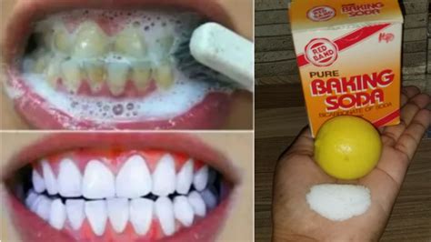 Teeth Before And After Baking Soda