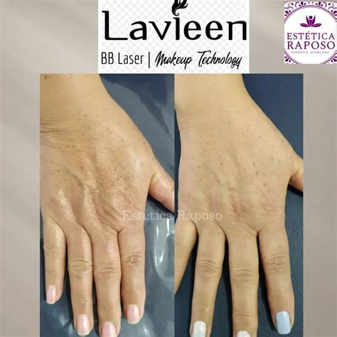 Labioplastia Laser Antes E Depois - Laser Lavieen – Estética Raposo