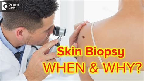 Skin Biopsy Why Is It Done Complications And Hospitalisation Dr