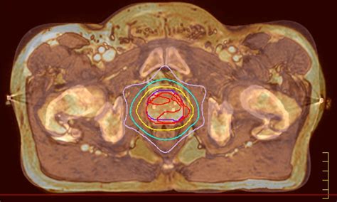 Mri In Rt A New Vision For Radiotherapy Philips Healthcare