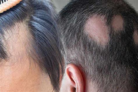 Sa K Ran Alopesi Areata Nedir Sa K Ran Belirtileri Neler Sa K Ran