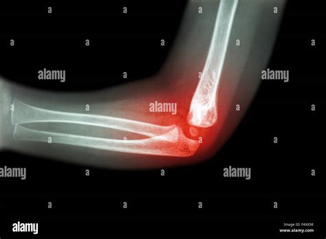 Rheumatoid arthritis , Gouty arthritis ( film x-ray child 's elbow with ...