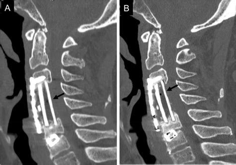 A 72 Year Old Man Underwent Anterior Cervical Corpectomy And Fusion Due Download Scientific