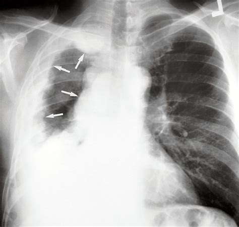 Pleural Thickening Effusion