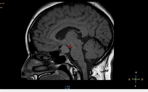 Sagittal view on T1 showing the hamartoma | Download Scientific Diagram