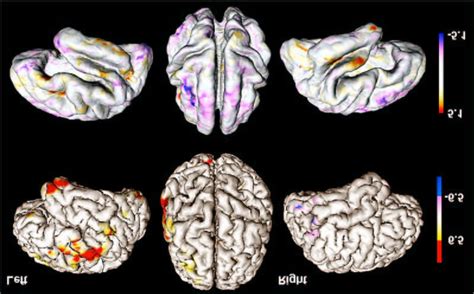 Top T Map Of Local Gray Matter Change Computed In 3D And Then