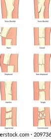 Types Bone Fractures Infographic Vector Stock Vector Royalty Free