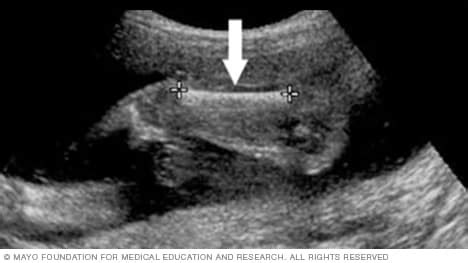 Femur Length Fetal Ultrasound