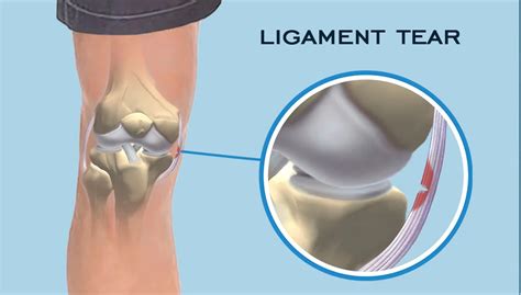 Medial Collateral Ligament Dr Rahul Bade