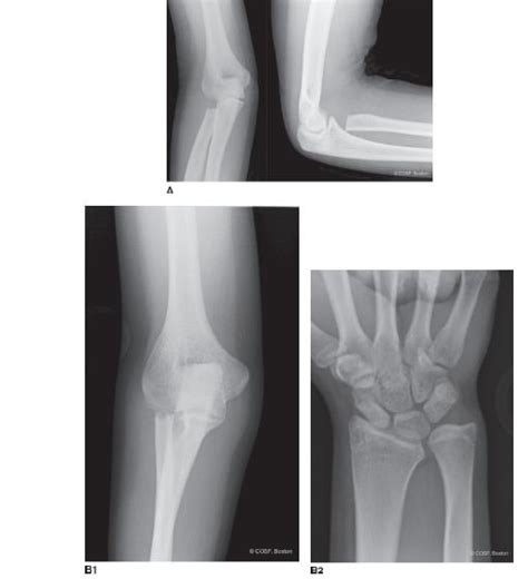 Congenital Radial Head Dislocation Obgyn Key