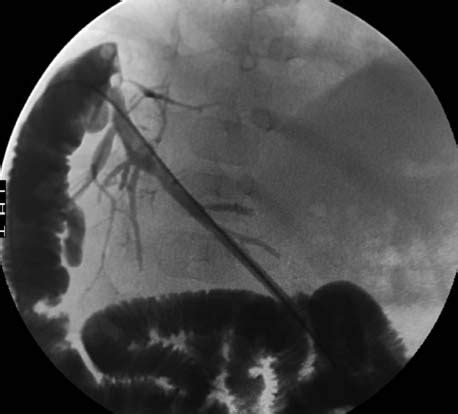 A Cholangiogram Of The Segment Iii Bile Duct Shows A Patent Biliary