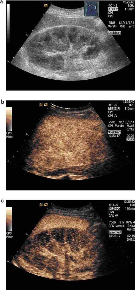 Sonographic Patterns Of Renal Lymphoma In B Mode Imaging And In