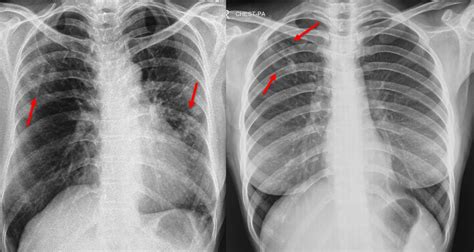 Chest X-ray for Screening for Tuberculosis