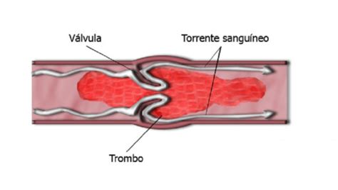 Embolia cerebral tipos síntomas secuelas y causas