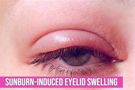 Does Sunlight Cause Swollen Eyelids Uv Rays Affect Eyes