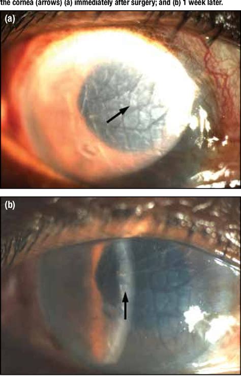 Figure 1 From Surgical Repair Of Descemet’s Membrane Detachment Following Phacoemulsification By