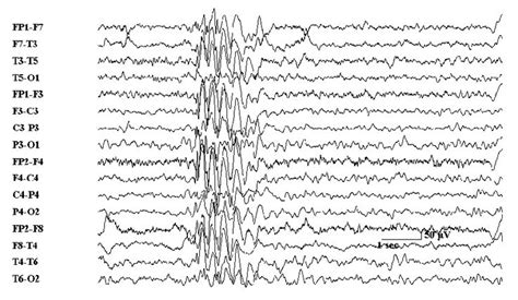 Eeg In Common Epilepsy Syndromes Epilepsy Myoclonic Epilepsy