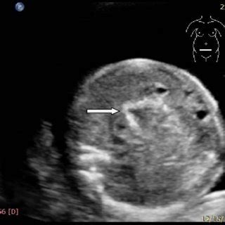 Twin fetus in fetu with immature teratoma. | Download Scientific Diagram