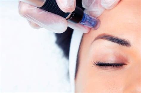 Qu Es El Microneedling Y Sus Beneficios Al Tratar Acn Arrugas Y