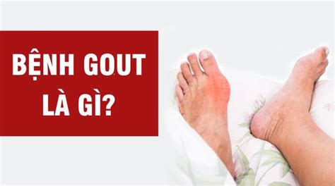 Gout Là Gì Dấu Hiệu Và Cách điều Trị Bệnh Gout