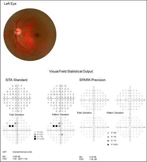 Illustrative Example Of A 69 Year Old Female Glaucoma Patient Sita