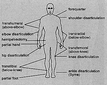 Levels Of Lower Limb Amputation