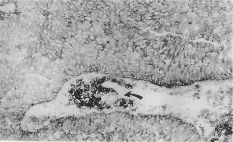 A Transitional Cell Carcinoma Of Similar Grade And Stage To The Tumour Download Scientific