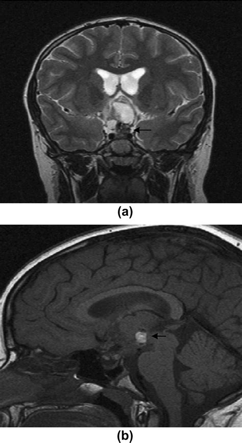 Imaging Characteristics Of Common Suprasellar Lesions With Emphasis On